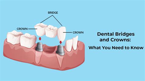 Potential gap issue between crown and case 